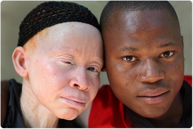 Unidentified albino mother and son. Image Credit: By Dietmar Temps / Shutterstock